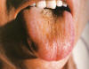 淡紫胖大舌灰黄腻苔。主病：虚人外感表邪入里化热；湿热瘀阻，痰热夹瘀。辨证：阳虚湿郁，化热动风。可见于老年震颤麻痹综合征。