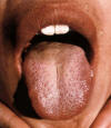 红舌红点白腻苔（红星舌）。主病：外感风寒失解，热入营血；湿浊、痰饮、食积停滞而化热。辨证：肝胆湿热，引动心火。可见于胆道感染等感染发热疾病。