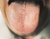 淡红裂纹舌薄白苔。主病：老年阴虚；脾虚湿侵。辨证：阴虚肝风内动。可见于功能性多动症、心血管病、感冒等。