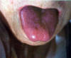 绛紫胖嫩光莹舌。主病：热入营血，气津两伤；热极伤阴，气血壅滞。辨证：热邪入血，伤及肝肾。可见于肺部感染等高热、脱水、中毒疾患。