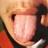 淡红齿痕舌薄白滑润苔。主病：外感湿邪；气虚湿盛；正常人。辨证：脾虚湿盛体质。常见于轻微的慢性病。