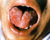 舌疮。主病：心经热毒；虚火上浮；湿热上泛。辨证：肾阴虚，胃热湿浊上泛。可见于溃疡性舌炎、口炎。