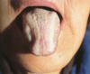 淡白舌白腻苔。主病：脾胃虚寒，湿滞中焦。辨证：气虚痰湿瘀阻。常见于慢性支气管炎、肺心病等。