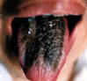 绛色红点舌黑绿糙裂苔。主病：热毒内实；血蕴湿热；热毒乘心。辨证：风痰上扰，痰热腑实。