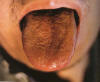 暗红舌焦黄燥裂苔。主病：阳阴实热重证；胃肠热结气血壅滞。辨证：中风，胃肠热结，腑气不通。可见于脑血管意外，感染发热性疾患。