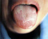 淡红舌类剥水滑苔。主病：久病气血不续；寒湿痰饮停聚。辨证：脾虚湿盛。常见于慢性胃炎等消化系统疾患及营养不良等。