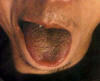 红绛晦暗舌焦黄燥裂苔。主病：实热重证；热极伤阴。辨证：痰热交阻，胃肠燥结。常见于脑出血等脑血管意外及发热疾患。