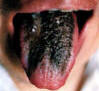 绛色红点舌黑绿糙裂苔。主病：热毒内实；血蕴湿热；热毒乘心。辨证：风痰上扰，痰热腑实。