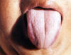淡紫舌白腻苔。主病：阳气不足而血瘀；湿邪内阻而夹瘀。辨证：脾肾阳虚，肝郁血滞。可见于柯兴氏综合征等内分泌系统疾患。
