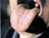 淡红舌薄白腻苔。主病：风寒湿邪在表；痰湿内结。辨证：脾虚湿盛。可见于各种心脏病，气管炎，消化不良等。